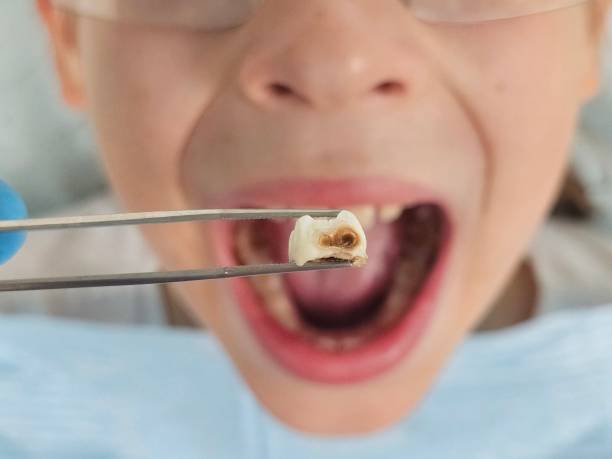Best Emergency Root Canal Treatment in Tupelo, MS