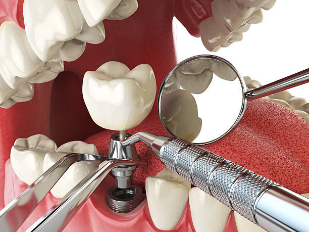 Best Emergency Tooth Extraction in Tupelo, MS